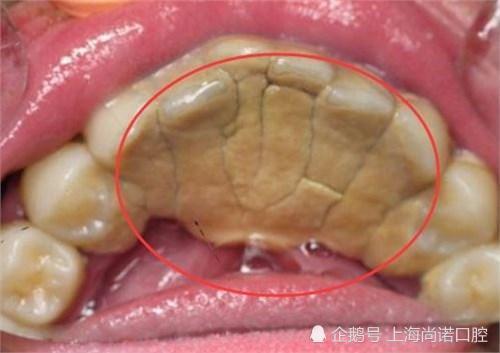 牙结石的预防措施和清除方法