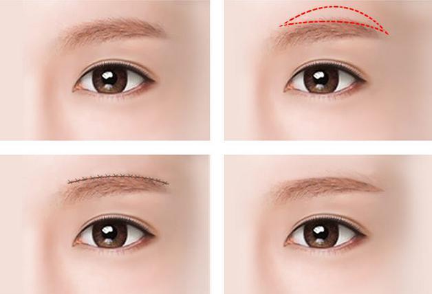 切眉术的适合各种年龄段人群,通过手术可以最大程度地减轻衰老的面相.