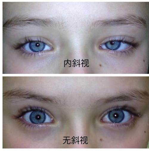 左眼光点在瞳孔中央,右眼光点偏内侧,为外斜视那内斜视有什么危害呢?